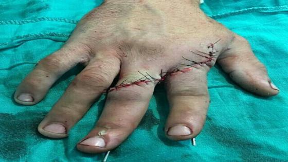 وجدة:مستشفى الفاربي ينجح في إعادة أصابع مبتورة في عملية ناجحة