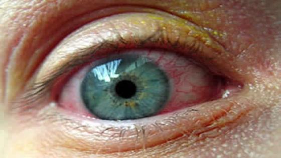 إكتشاف علاج جديد يقي المصابين بمرض السكري من العمى
